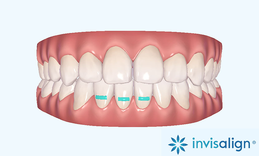 治療を始める前に治療終了までの歯の動きを確認出来る
