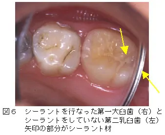 シーラント