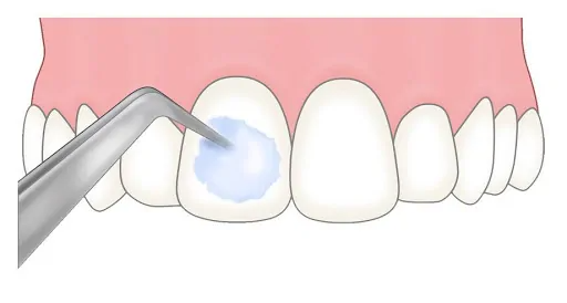 フッ素（フッ化物）ってどんな効果があるの？